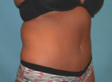 Tummy Tuck