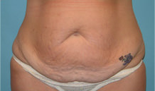 Tummy Tuck