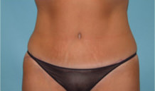 Tummy Tuck