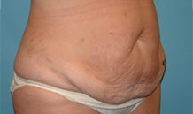 Tummy Tuck