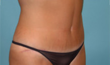 Tummy Tuck