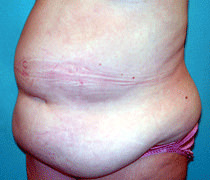 Tummy Tuck