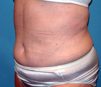 Tummy Tuck