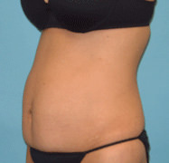 Tummy Tuck