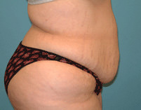 Tummy Tuck