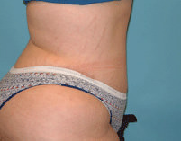 Tummy Tuck