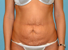 Tummy Tuck