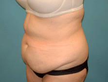 Tummy Tuck