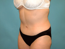 Tummy Tuck