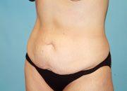 Tummy Tuck