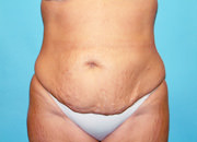 Tummy Tuck