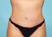 Tummy Tuck