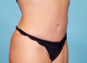 Tummy Tuck