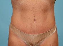 Tummy Tuck