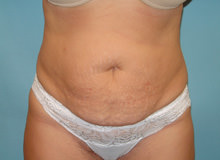 Tummy Tuck