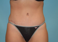 Tummy Tuck