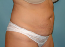 Tummy Tuck