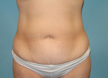 Tummy Tuck