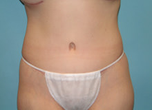 Tummy Tuck