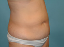 Tummy Tuck