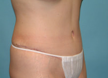 Tummy Tuck