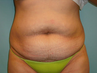 Tummy Tuck