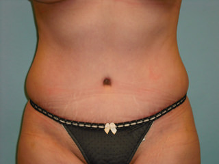 Tummy Tuck