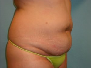 Tummy Tuck