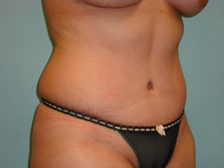 Tummy Tuck