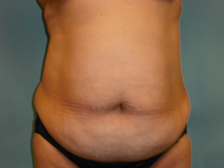 Tummy Tuck