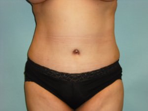 Tummy Tuck