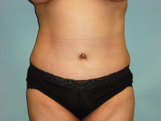 Tummy Tuck