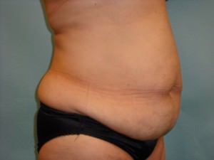 Tummy Tuck