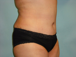 Tummy Tuck