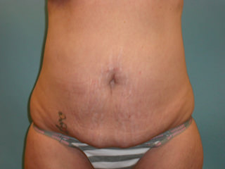 Tummy Tuck