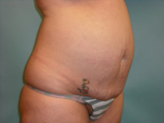 Tummy Tuck