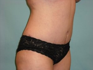 Tummy Tuck