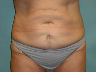 Tummy Tuck