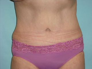 Tummy Tuck