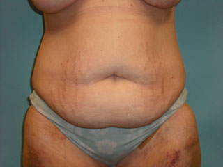 Tummy Tuck