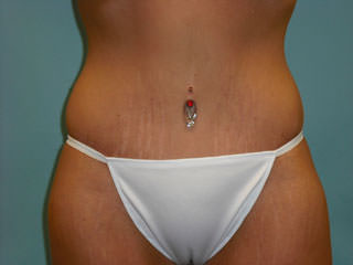 Tummy Tuck