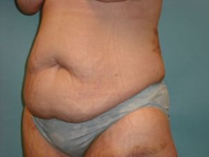 Tummy Tuck