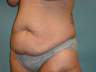 Tummy Tuck