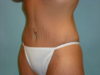 Tummy Tuck