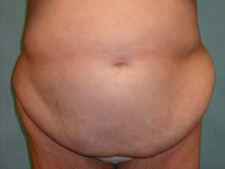 Tummy Tuck