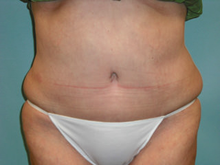 Tummy Tuck