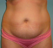 Tummy Tuck