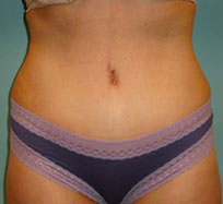 Tummy Tuck