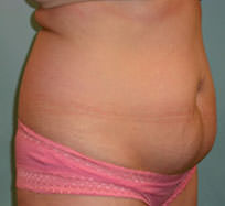 Tummy Tuck