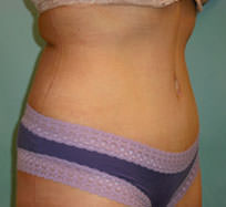 Tummy Tuck